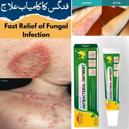 Psoriasis, Fungal & Eczema Care Cream – Skin Relief Formula
