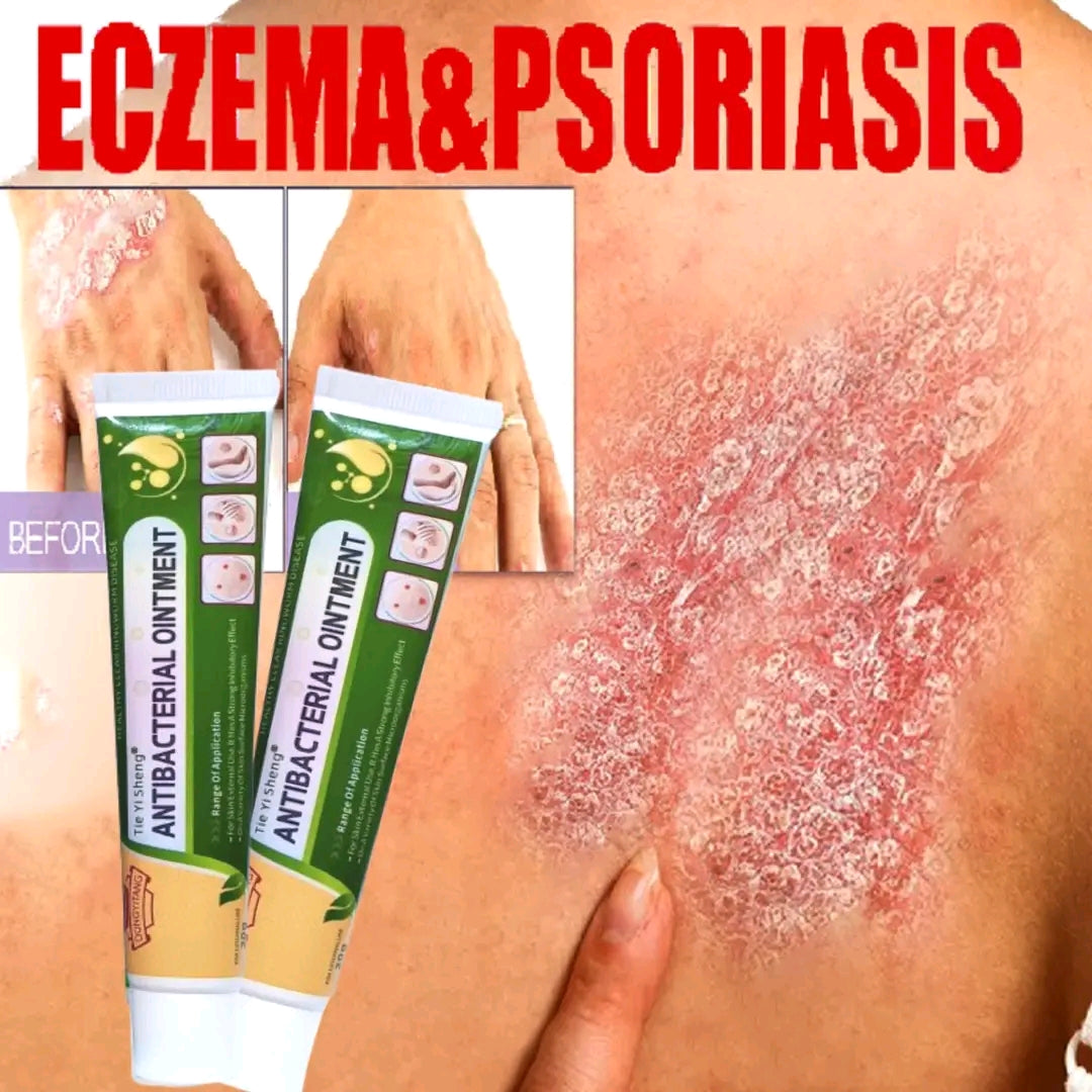 Psoriasis, Fungal & Eczema Care Cream – Skin Relief Formula