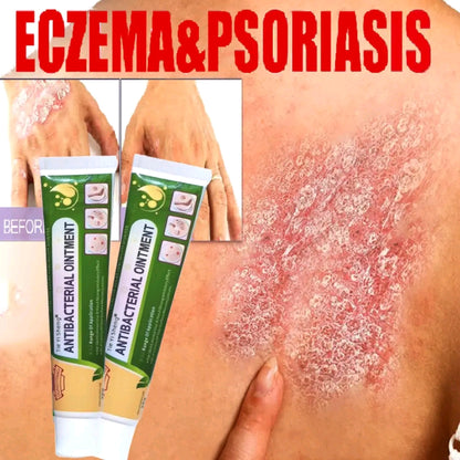Psoriasis, Fungal & Eczema Care Cream – Skin Relief Formula