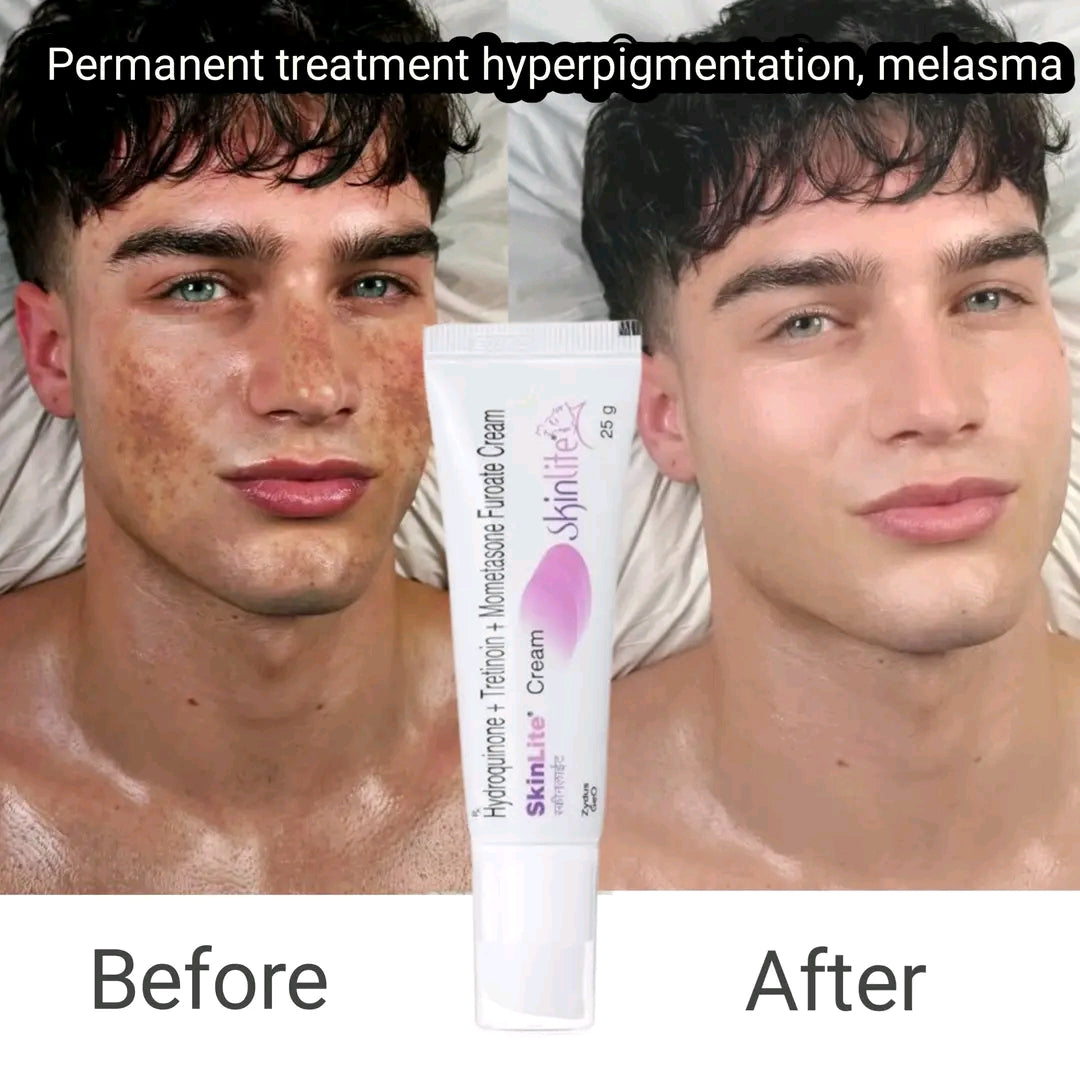 Whitening Cream for Melasma, Hyperpigmentation & Dark Spots | Brightening Skin Care
