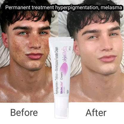 Whitening Cream for Melasma, Hyperpigmentation & Dark Spots | Brightening Skin Care
