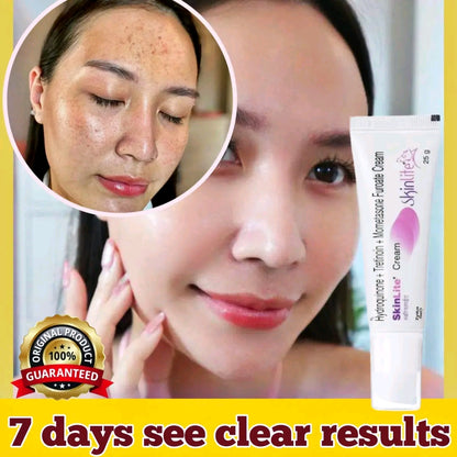 Whitening Cream for Melasma, Hyperpigmentation & Dark Spots | Brightening Skin Care