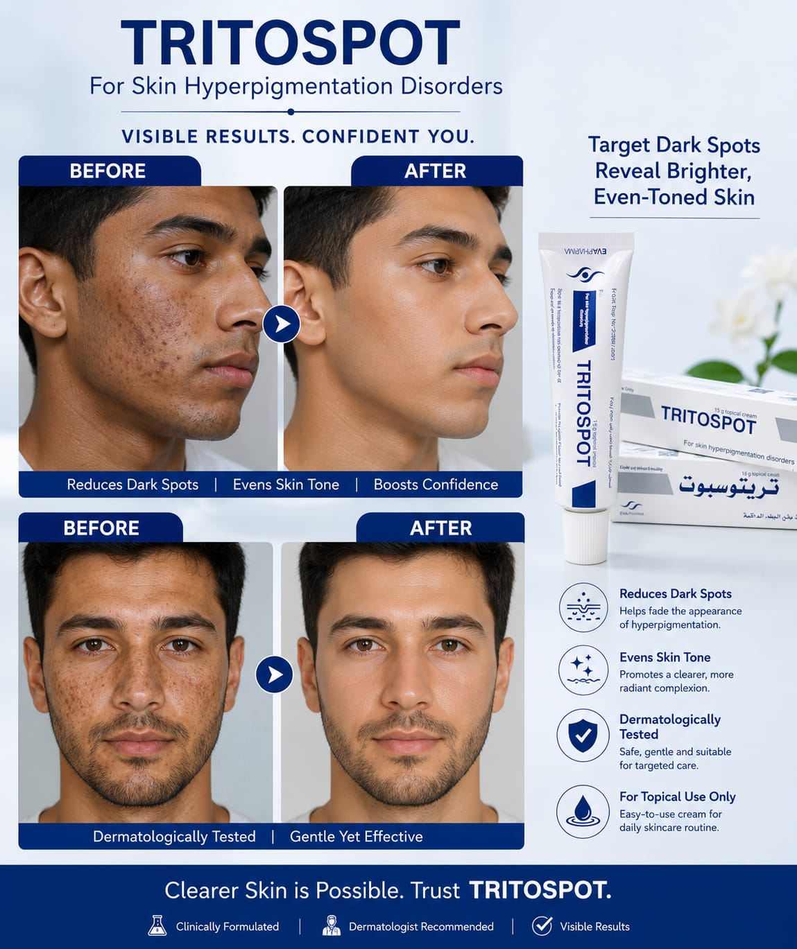 Whitening Cream for Melasma, Hyperpigmentation & Dark Spots Treatment