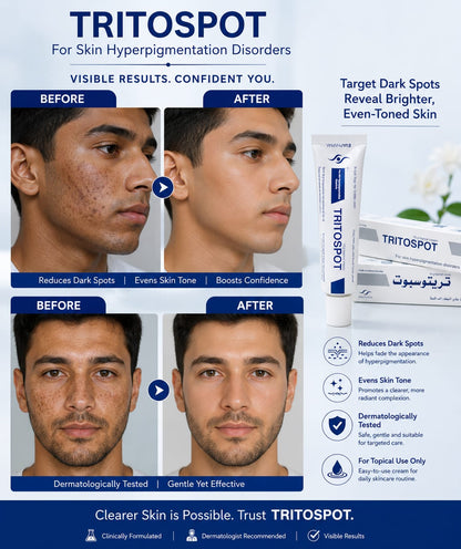 Whitening Cream for Melasma, Hyperpigmentation & Dark Spots Treatment